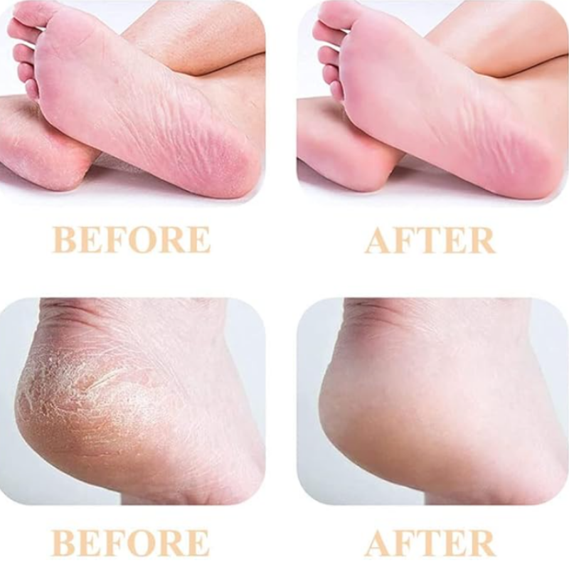 FileGrinder - Foot Grinder Callus Remover File Refill
