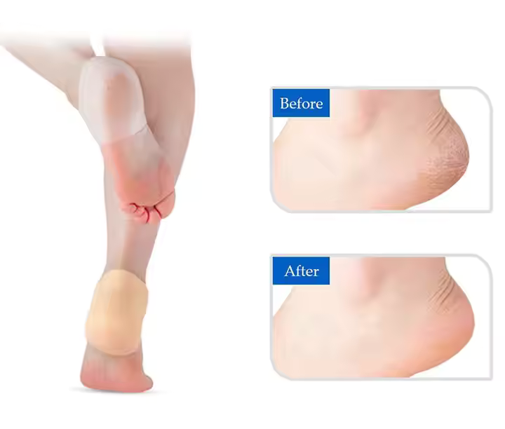 Happy™ HeelProtector 1+1 FREE - Soft Silicone Heel Protector